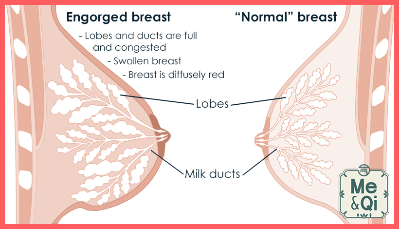 Engorged breast versus normal breast