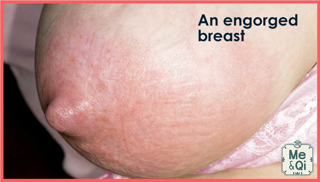 Engorged breast, engorgement