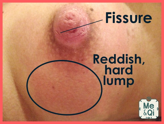 Nipple fissure and clogged duct