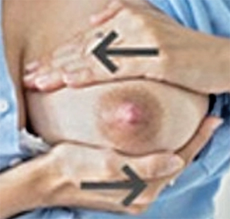 Breast massage against clogged milk ducts step 5 bis