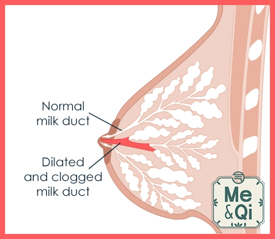 Clogged duct (plugged duct)