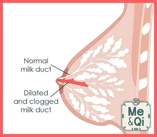 Clogged duct (plugged duct)