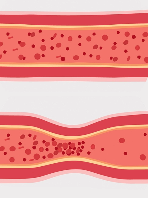A normal vessel (top) versus vasospam (bottom)