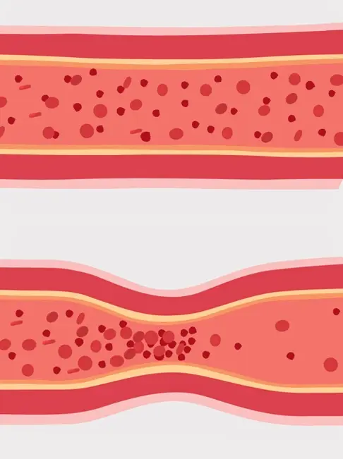 A normal vessel (top) versus vasospam (bottom)
