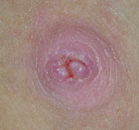 Chapped Nipple Breastfeeding Picture