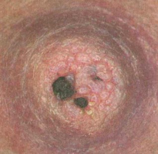 Scab Nipple Breastfeeding Or Pumping