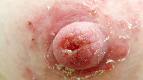 Peeling Nipple and arola breastfeeding