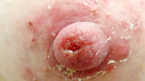 Peeling Nipple and arola breastfeeding