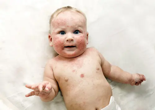 Baby Eczema with red and itchy skin