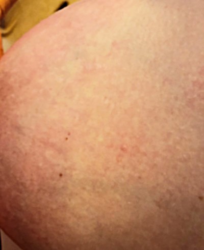 Clogged Milk Duct Picture 