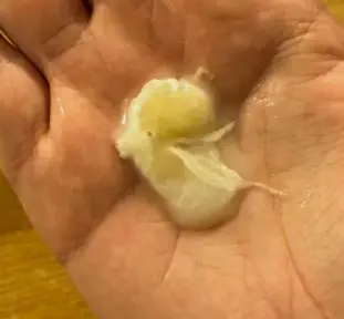 Clogged Duct Thickend Breast Milk