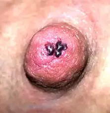 Blood Blister On Nipple
