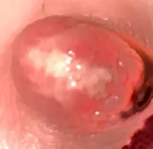 Clear Blister On Nipple