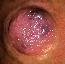 Dark Blister On Nipple