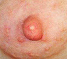 Blister On Areola Or Breast