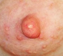 Blister On Areola Or Breast