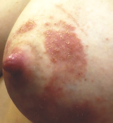 Breast Eczema with red, peeling and itchy skin